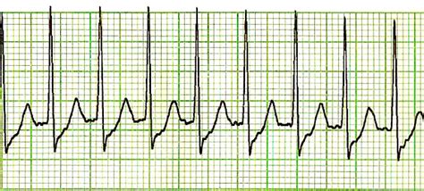 Supraventricular tachycardia - Wikipedia