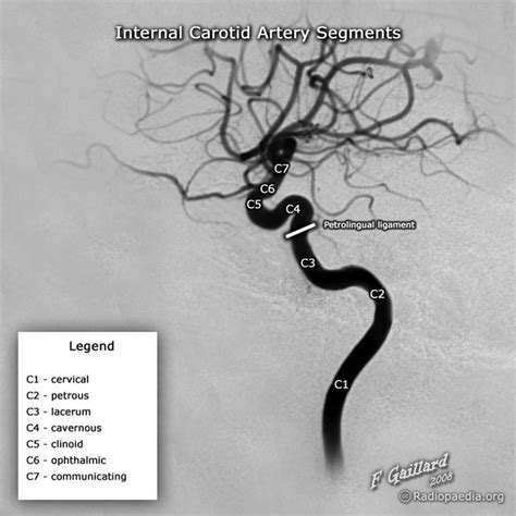 صورة ذات صلة | Internal carotid artery, Carotid artery, Radiology