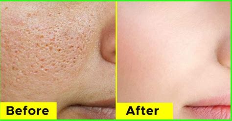 5 Best Natural Home Remedies for Open Pores On Face