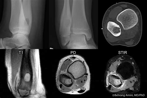 Roentgen Ray Reader: Osteoblastoma