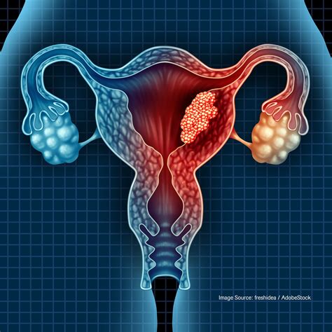 Trial Failure Still Yields Insights for Uterine Leiomyosarcoma