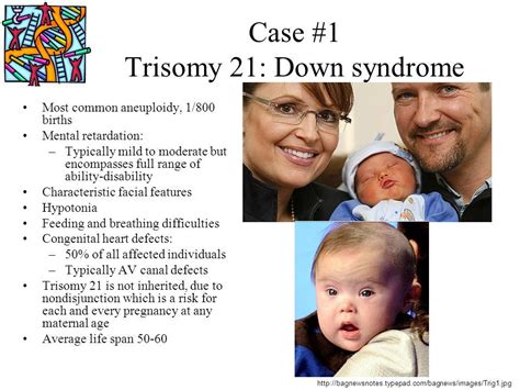 Trisomy 21 Down Syndrome - Down Syndrome (Trisomy 21) : A child with ...