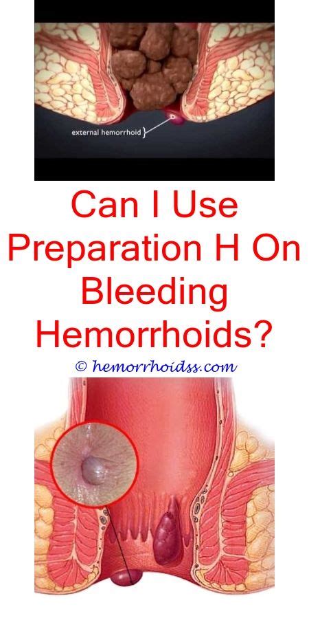 Can Aspirin Cause Hemorrhoids To Bleed? | Hemorrhoid remedies, Bleeding ...