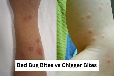 Chigger Bites vs. Bed Bug Bites: How to Tell Them Apart