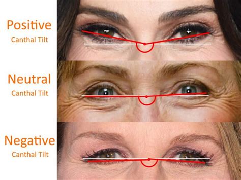 eye-positve-neutral-negative-canthal-tilts – PinkMirror Blog