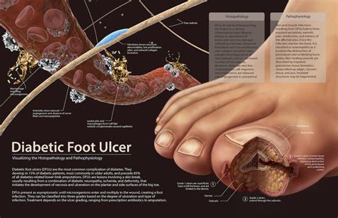 Diabetic foot ulcers: Surgery options to treat and prevent podiatric ...