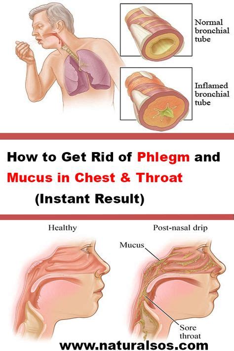 How to Get Rid of Phlegm and Mucus in Chest & Throat (Instant Result ...