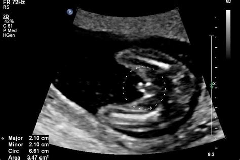 21 Weeks Pregnant Ultrasound Gender