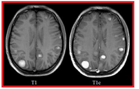 Comparison between a T1-Weighted MRI sequence without a contrast agent ...