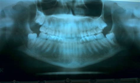 Day 8 wisdom | Dental bridge, Dental implants cost, Dental hygenist