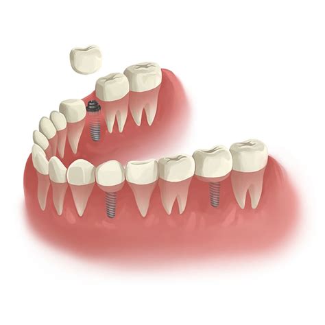 The Benefits of Wisdom Teeth Removal – avilamistica