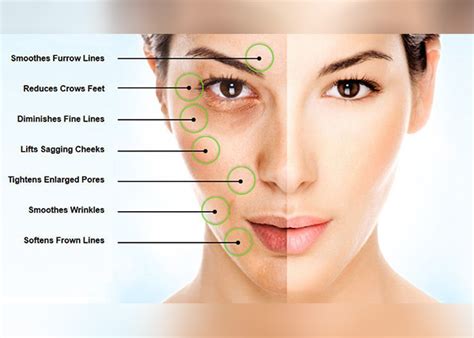 Micro Needling Face Chart | Images and Photos finder