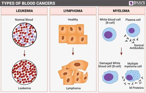 Blood Cancer- Types, Symptoms, Causes and its Treatment