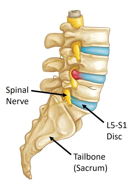 Treating an L5-S1 Disc Herniation: A Case Study - Regenexx