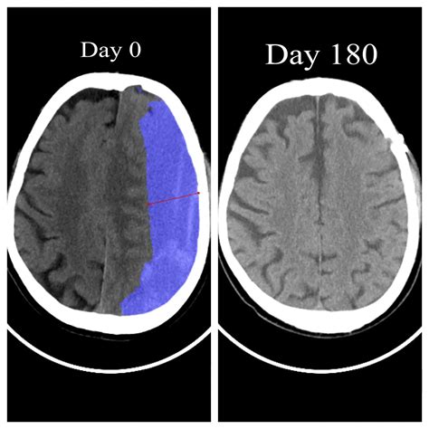 Subdural hematoma surgery - What you should know