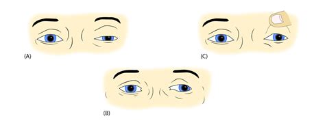 Third Cranial Nerve Palsy | Vision Performance Optometric Center