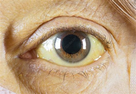 Kayser-Fleischer ring in eye due to liver disease - Stock Image - C046 ...