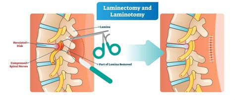 Laminotomy Vs. Laminectomy: What's The Difference? | New Jersey ...