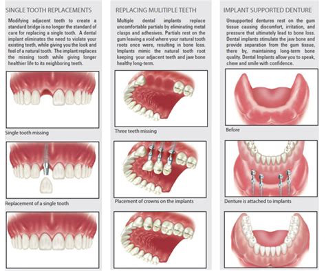 Types of Dental Implant |Dental Clinic in Madurai | Agaram Dental ...