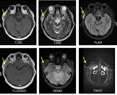 Scalp arteriovenous malformation mistaken for a hemangioma – Radiology ...