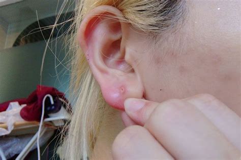 Tips to Get Rid of Pimple in Earlobe