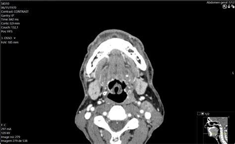 SciELO - Brasil - Omega-shaped epiglottis: a challenge Omega-shaped ...