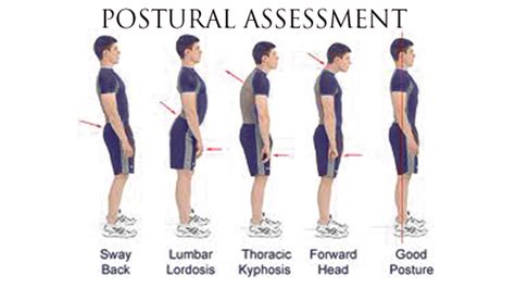 Abnormal Posture : Type, Cause, Symptom's, Exercise