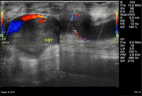 Dialysis Fistula Ultrasound