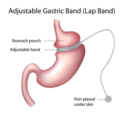 Lap Band | Brisbane Weight Loss Surgery