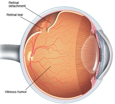 Retinal Detachment - Causes, Signs, Symptoms, Surgery, Repair