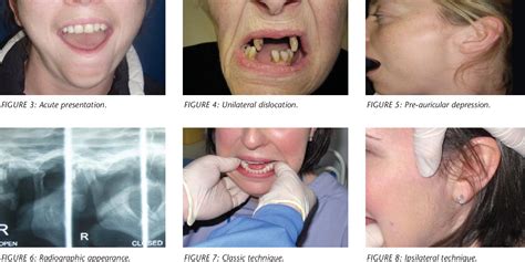 [PDF] Management of acute dislocation of the temporomandibular joint in ...