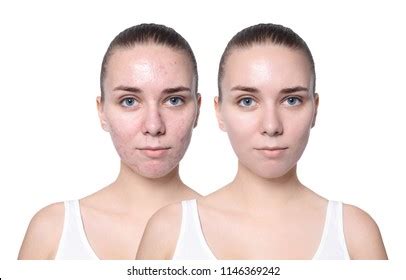 Young Woman Before After Acne Treatment Stock Photo 1146369242 ...