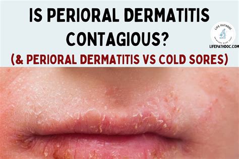 Is perioral dermatitis contagious? & Perioral dermatitis vs herpes