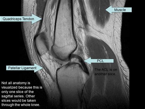 Mri Images Of Problem Knee