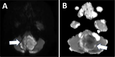 -(A) Diffusion-weighted image and (B) apparent diffusion coefficient ...