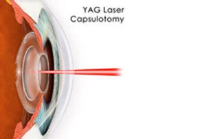 YAG Laser Procedure at Eye Care Associates of Nevada - Eye Care ...