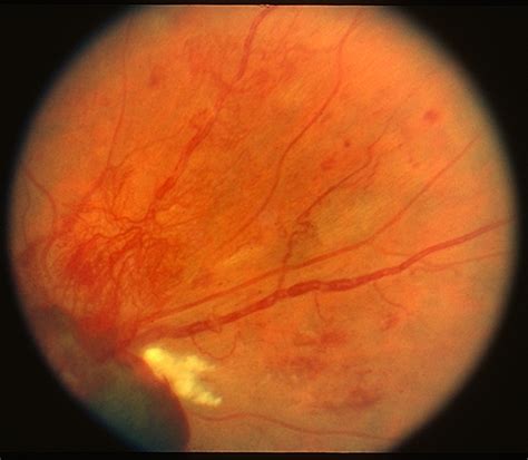 Retinal Neovascularization - Retina Image Bank