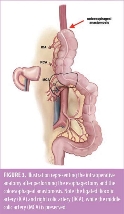 Colonic Interposition Graft as a Conduit following Esophagectomy for ...