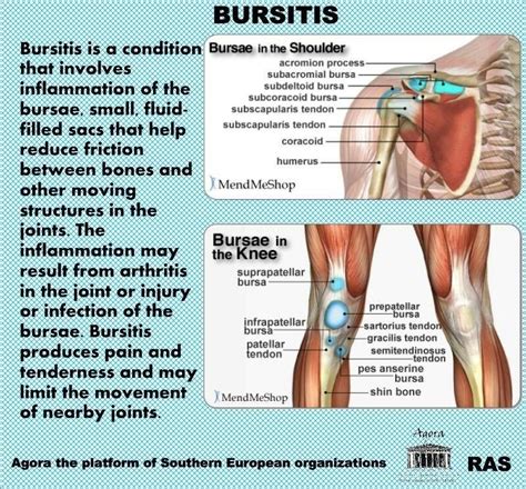 Bursitis | Bursitis knee, Bursitis symptoms, Bursitis