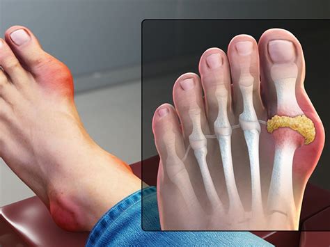 Gout in big toe: How to identify, causes, and treatment