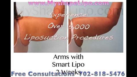 liposuction arms before and after - Liposuction - Vaser Lipo