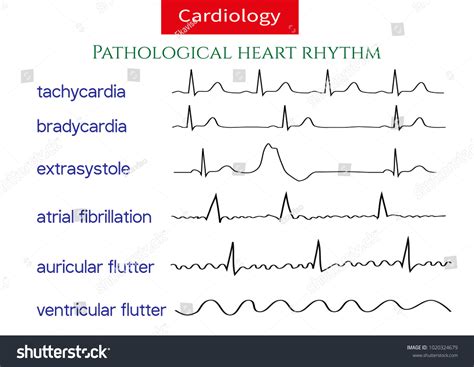 4,000 Ecg Arrhythmia Images, Stock Photos & Vectors | Shutterstock