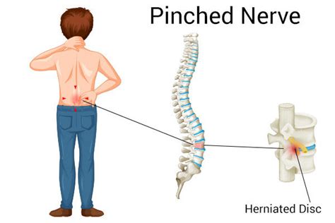 Pinched Nerve Physical Therapy Chiropractic Chart | ubicaciondepersonas ...