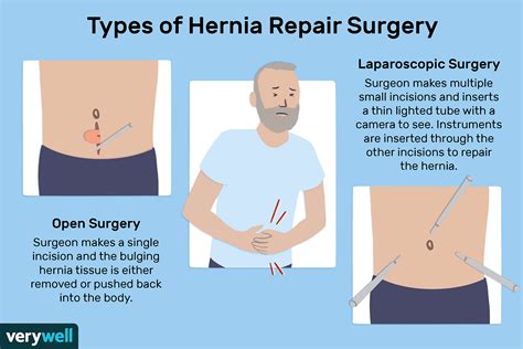 What to Expect From Hernia Repair Surgery (2022)