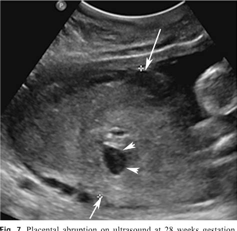 Placental Hemorrhage Ultrasound