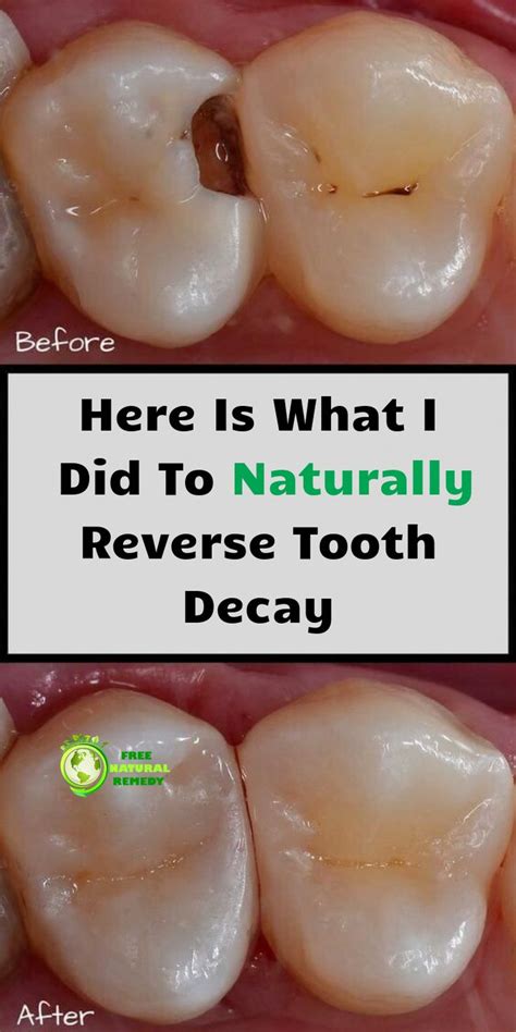 Here Is What I Did To Naturally Reverse Tooth Decay. in 2020 | Tooth ...