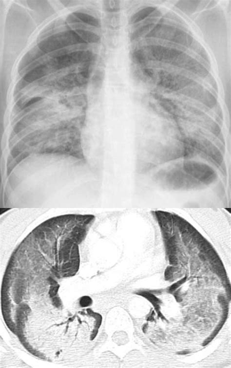 Drug induced-lung disease - EMCrit Project