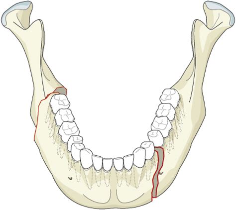 Maxillofacial Trauma Mandibular Fractures | The Best Porn Website