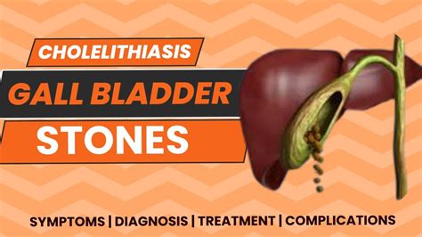 Cholelithiasis | GallStones | Gallbladder Stones | Symptoms | Diagnosis ...