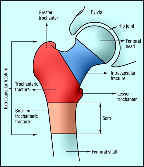 Hip fracture | The BMJ